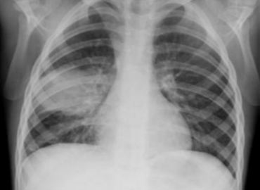 Pneumoni.JPG